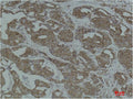 Immunohistochemical analysis of paraffin-embedded Human Breast Carcinoma using Calnexin Polyclonal Antibody.