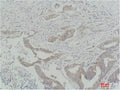 Immunohistochemical analysis of paraffin-embedded Human Colon Carcinoma using Raf-1 Polyclonal Antibody.