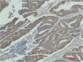 Immunohistochemical analysis of paraffin-embedded Human Colon Carcinoma using MEK-1 Polyclonal Antibody.