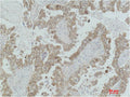 Immunohistochemical analysis of paraffin-embedded Human Lung Carcinoma using MEK-2 Polyclonal Antibody.