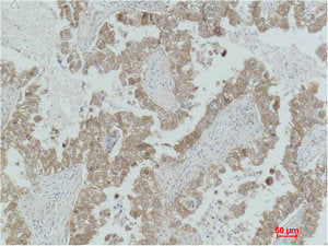 Immunohistochemical analysis of paraffin-embedded Human Lung Carcinoma using MEK-2 Polyclonal Antibody.