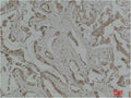 Immunohistochemical analysis of paraffin-embedded Human Breast Carcinoma using MEK-5 Polyclonal Antibody.