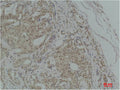 Immunohistochemical analysis of paraffin-embedded Human Breast Carcinoma using TGFβ1 Polyclonal Antibody.