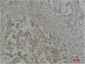 Immunohistochemical analysis of paraffin-embedded Human Breast Carcinoma using Stat1 Polyclonal Antibody.