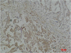Immunohistochemical analysis of paraffin-embedded Human Breast Carcinoma using Stat1 Polyclonal Antibody.