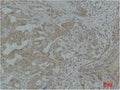 Immunohistochemical analysis of paraffin-embedded Human Breast Carcinoma using Stat3 Polyclonal Antibody.