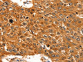 The image on the left is immunohistochemistry of paraffin-embedded Human esophagus cancer tissue using CSB-PA080360(SERPINB5 Antibody) at dilution 1/60, on the right is treated with fusion protein. (Original magnification: ×200)