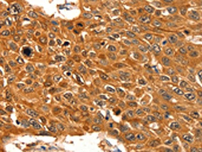The image on the left is immunohistochemistry of paraffin-embedded Human esophagus cancer tissue using CSB-PA080360(SERPINB5 Antibody) at dilution 1/60, on the right is treated with fusion protein. (Original magnification: ×200)