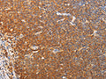The image on the left is immunohistochemistry of paraffin-embedded Human lymphoma tissue using CSB-PA080378(SRC Antibody) at dilution 1/20, on the right is treated with fusion protein. (Original magnification: ×200)