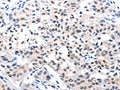 The image on the left is immunohistochemistry of paraffin-embedded Human lung cancer tissue using CSB-PA081015(IL18 Antibody) at dilution 1/120, on the right is treated with fusion protein. (Original magnification: ×200)