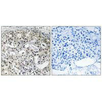 Immunohistochemistry analysis of paraffin-embedded human breast carcinoma tissue using CNTD2 antibody.