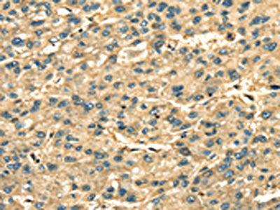 The image on the left is immunohistochemistry of paraffin-embedded Human liver cancer tissue using CSB-PA081479(ANXA2 Antibody) at dilution 1/35, on the right is treated with fusion protein. (Original magnification: ×200)