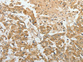 The image on the left is immunohistochemistry of paraffin-embedded Human breast cancer tissue using CSB-PA081579(TEKT1 Antibody) at dilution 1/30, on the right is treated with fusion protein. (Original magnification: ×200)