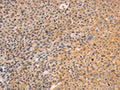 The image on the left is immunohistochemistry of paraffin-embedded Human liver cancer tissue using CSB-PA081645(SRC Antibody) at dilution 1/10, on the right is treated with fusion protein. (Original magnification: ×200)
