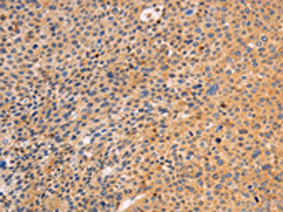 The image on the left is immunohistochemistry of paraffin-embedded Human liver cancer tissue using CSB-PA081645(SRC Antibody) at dilution 1/10, on the right is treated with fusion protein. (Original magnification: ×200)