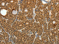 The image on the left is immunohistochemistry of paraffin-embedded Human thyroid cancer tissue using CSB-PA081737(SKP1 Antibody) at dilution 1/25, on the right is treated with fusion protein. (Original magnification: ×200)