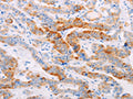 The image on the left is immunohistochemistry of paraffin-embedded Human thyroid cancer tissue using CSB-PA082361(MAP4K3 Antibody) at dilution 1/30, on the right is treated with fusion protein. (Original magnification: ×200)