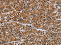 The image on the left is immunohistochemistry of paraffin-embedded Human prostate cancer tissue using CSB-PA082388(IL2RG Antibody) at dilution 1/30, on the right is treated with fusion protein. (Original magnification: ×200)