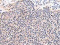 The image on the left is immunohistochemistry of paraffin-embedded Human lung cancer tissue using CSB-PA082817(CCL7 Antibody) at dilution 1/20, on the right is treated with synthetic peptide. (Original magnification: ×200)