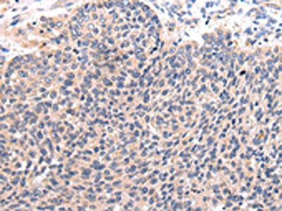 The image on the left is immunohistochemistry of paraffin-embedded Human lung cancer tissue using CSB-PA082817(CCL7 Antibody) at dilution 1/20, on the right is treated with synthetic peptide. (Original magnification: ×200)
