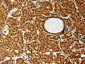 The image on the left is immunohistochemistry of paraffin-embedded Human thyroid cancer tissue using CSB-PA082936(AKR1A1 Antibody) at dilution 1/30, on the right is treated with synthetic peptide. (Original magnification: ×200)
