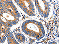The image on the left is immunohistochemistry of paraffin-embedded Human colon cancer tissue using CSB-PA082992(IGFBP7 Antibody) at dilution 1/50, on the right is treated with synthetic peptide. (Original magnification: ×200)