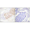 Immunohistochemistry analysis of paraffin-embedded human breast carcinoma tissue using EDD antibody.