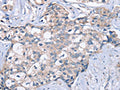 The image on the left is immunohistochemistry of paraffin-embedded Human breast cancer tissue using CSB-PA083173(KCNQ5 Antibody) at dilution 1/60, on the right is treated with fusion protein. (Original magnification: ×200)