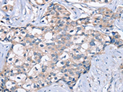 The image on the left is immunohistochemistry of paraffin-embedded Human breast cancer tissue using CSB-PA083173(KCNQ5 Antibody) at dilution 1/60, on the right is treated with fusion protein. (Original magnification: ×200)