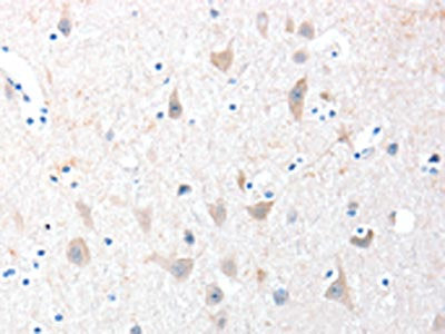 The image on the left is immunohistochemistry of paraffin-embedded Human brain tissue using CSB-PA083230(ADAM20 Antibody) at dilution 1/30, on the right is treated with fusion protein. (Original magnification: ×200)