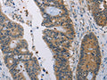 The image on the left is immunohistochemistry of paraffin-embedded Human colon cancer tissue using CSB-PA083278(AMBP Antibody) at dilution 1/35, on the right is treated with fusion protein. (Original magnification: ×200)