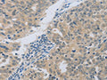 The image on the left is immunohistochemistry of paraffin-embedded Human ovarian cancer tissue using CSB-PA083281(MAGEB4 Antibody) at dilution 1/50, on the right is treated with fusion protein. (Original magnification: ×200)