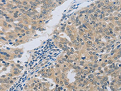 The image on the left is immunohistochemistry of paraffin-embedded Human ovarian cancer tissue using CSB-PA083281(MAGEB4 Antibody) at dilution 1/50, on the right is treated with fusion protein. (Original magnification: ×200)