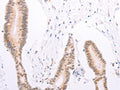 The image on the left is immunohistochemistry of paraffin-embedded Human colon cancer tissue using CSB-PA083402(ADAM12 Antibody) at dilution 1/30, on the right is treated with synthetic peptide. (Original magnification: ×200)