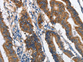 The image on the left is immunohistochemistry of paraffin-embedded Human colon cancer tissue using CSB-PA083591(MAD2L1BP Antibody) at dilution 1/60, on the right is treated with fusion protein. (Original magnification: ×200)