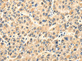 The image on the left is immunohistochemistry of paraffin-embedded Human liver cancer tissue using CSB-PA083735(TWIST2 Antibody) at dilution 1/35, on the right is treated with fusion protein. (Original magnification: ×200)