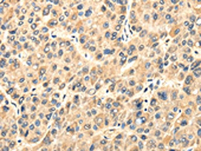 The image on the left is immunohistochemistry of paraffin-embedded Human liver cancer tissue using CSB-PA083735(TWIST2 Antibody) at dilution 1/35, on the right is treated with fusion protein. (Original magnification: ×200)