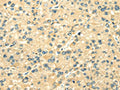 The image on the left is immunohistochemistry of paraffin-embedded Human liver cancer tissue using CSB-PA083780(TXN2 Antibody) at dilution 1/25, on the right is treated with fusion protein. (Original magnification: ×200)