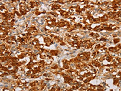 The image on the left is immunohistochemistry of paraffin-embedded Human thyroid cancer tissue using CSB-PA084239(BNIP3 Antibody) at dilution 1/20, on the right is treated with fusion protein. (Original magnification: ×200)