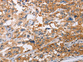 The image on the left is immunohistochemistry of paraffin-embedded Human esophagus cancer tissue using CSB-PA084492(NLRP3 Antibody) at dilution 1/15, on the right is treated with fusion protein. (Original magnification: ×200)