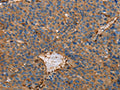 The image on the left is immunohistochemistry of paraffin-embedded Human liver cancer tissue using CSB-PA084581(ACTA1 Antibody) at dilution 1/65, on the right is treated with fusion protein. (Original magnification: ×200)