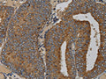 The image on the left is immunohistochemistry of paraffin-embedded Human colon cancer tissue using CSB-PA084695(MAS1 Antibody) at dilution 1/50, on the right is treated with fusion protein. (Original magnification: ×200)