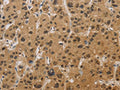 The image on the left is immunohistochemistry of paraffin-embedded Human liver cancer tissue using CSB-PA084737(HSPA4 Antibody) at dilution 1/20, on the right is treated with fusion protein. (Original magnification: ×200)