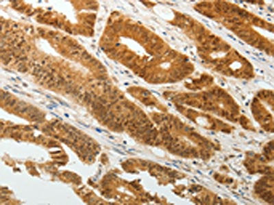 The image is immunohistochemistry of paraffin-embedded Human colon cancer tissue using CSB-PA084858(TWIST1 Antibody) at dilution 1/20. (Original magnification: ×200)