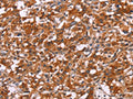 The image on the left is immunohistochemistry of paraffin-embedded Human thyroid cancer tissue using CSB-PA085605(HSPB6 Antibody) at dilution 1/30, on the right is treated with synthetic peptide. (Original magnification: ×200)