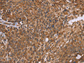 The image on the left is immunohistochemistry of paraffin-embedded Human ovarian cancer tissue using CSB-PA085809(PPIB Antibody) at dilution 1/45, on the right is treated with fusion protein. (Original magnification: ×200)