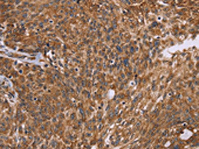 The image on the left is immunohistochemistry of paraffin-embedded Human ovarian cancer tissue using CSB-PA085809(PPIB Antibody) at dilution 1/45, on the right is treated with fusion protein. (Original magnification: ×200)