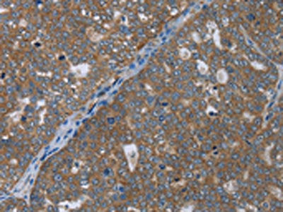 The image on the left is immunohistochemistry of paraffin-embedded Human ovarian cancer tissue using CSB-PA086437(GABRB1 Antibody) at dilution 1/50, on the right is treated with fusion protein. (Original magnification: ×200)
