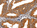 The image on the left is immunohistochemistry of paraffin-embedded Human cervical cancer tissue using CSB-PA086441(FGFR1 Antibody) at dilution 1/60, on the right is treated with fusion protein. (Original magnification: ×200)