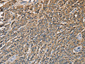 The image on the left is immunohistochemistry of paraffin-embedded Human prostate cancer tissue using CSB-PA086611(KLK1 Antibody) at dilution 1/40, on the right is treated with fusion protein. (Original magnification: ×200)
